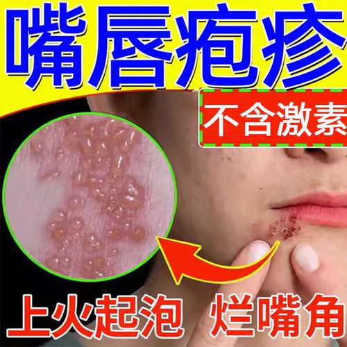 ftkh【大药房直发】嘴唇疱疹特傚膏上火起泡发炎嘴巴开裂嘴角脓疮溃疡