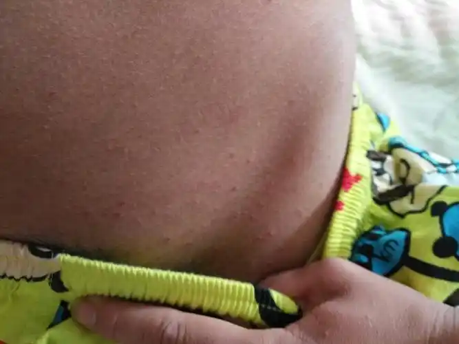 肚子下面都痘痘,还很痒