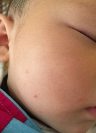 儿童软疣图片 (20)_有来医生