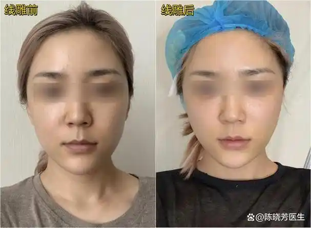 面部线雕的价格大概多少钱_面部线雕的价格大概多少钱啊