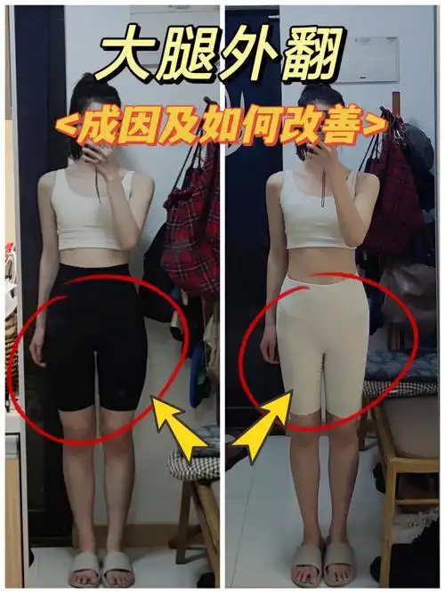 [星r]原因:大多数女生大腿肌肉外翻都是由于膝内扣,再加上女性本来就