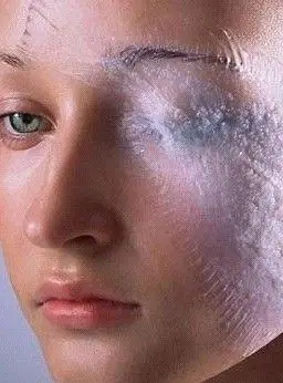 diy果酸灼伤皮肤