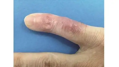 皮科新观察|皮肤脓肿分枝杆菌感染:如何诊断与治疗?