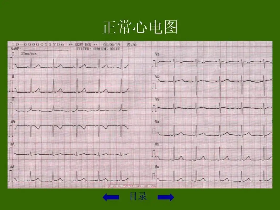 心电图讲座
