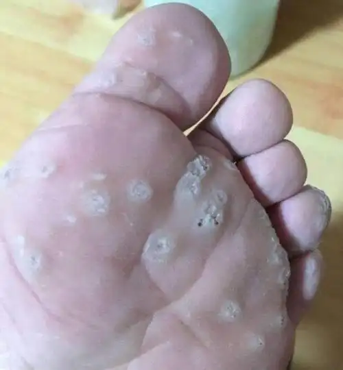 脚上长了鸡眼是什么样子的(脚上长了鸡眼是什么样子的图片)