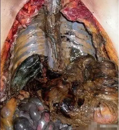 我从网上截的一个抽烟者肺部图片 想知道一下这是什么病 黑成这个样子