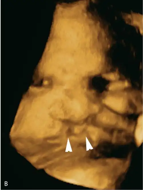 书摘笔记胎儿唇腭裂的超声诊断