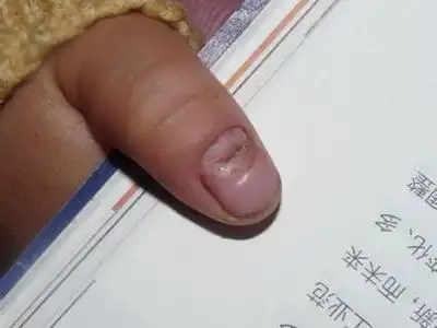 指甲凹陷图片 (25)_有来医生