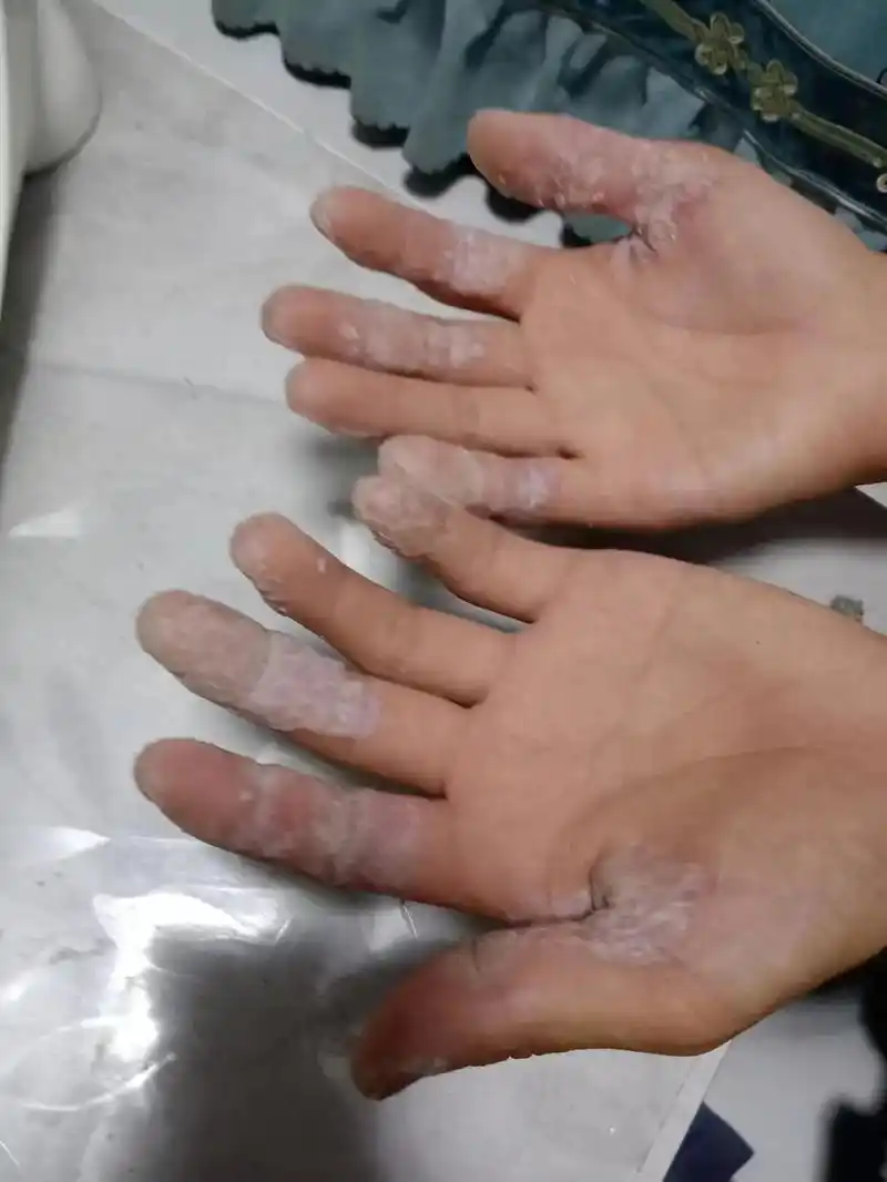 各种顽固皮肤病患者的福音牛皮癣手足癣包治包好无效退款