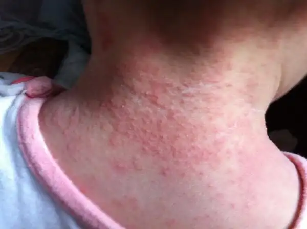 儿科医生说-是湿疹,还是痱子?