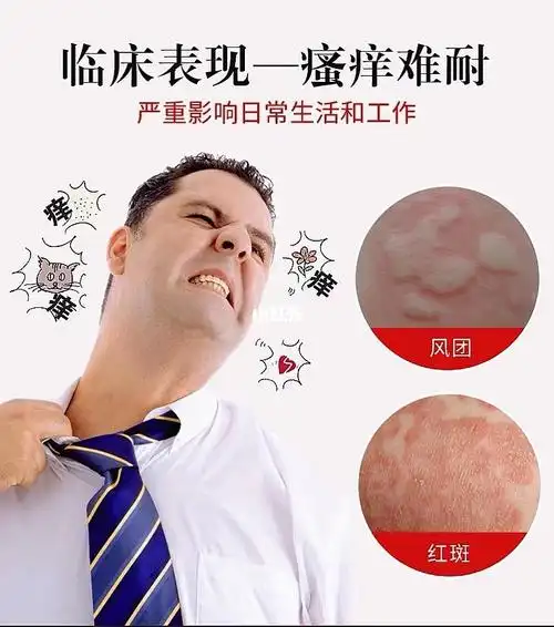荨麻疹风疹化妆品过敏紫外线过敏物理过敏