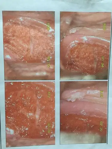 低危hpv 40为阳性,其它都是阴性, 阴道镜检查有菜花状物, 分泌物有