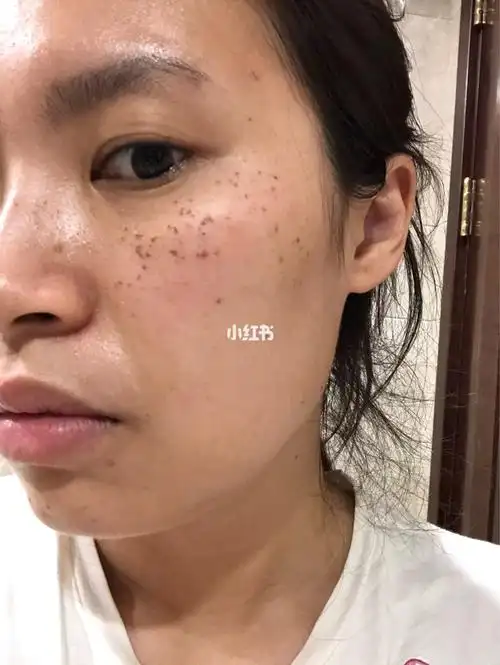 m22光子嫩肤第二天98开始结痂