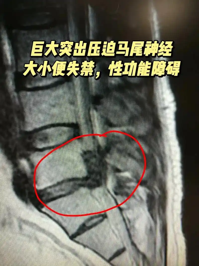 腰椎间盘突出有一种最凶险 - 抖音