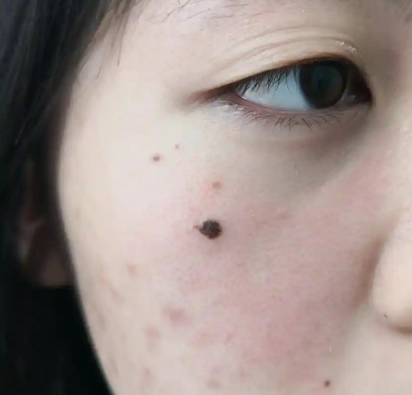 解决皮肤问题专注皮肤美容##色素痣