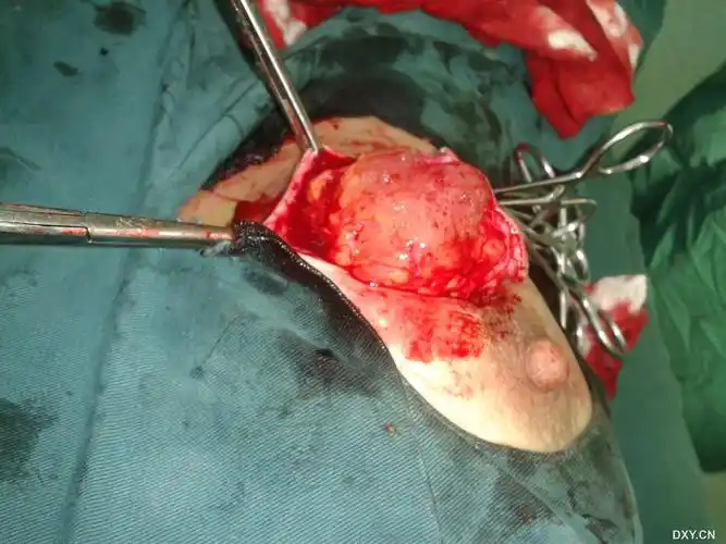 【求助】昨天下午做的一乳房肿块,切开却是…… [病例帖]