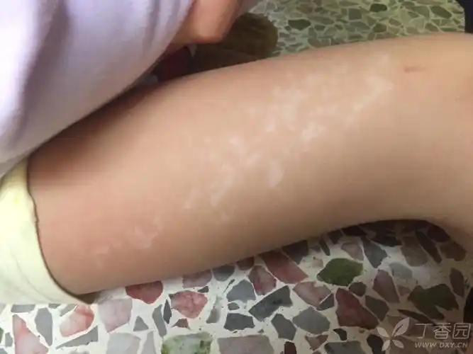 小孩大腿长 白斑 白癜风?