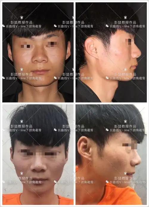 男性下颌骨长曲线v-line截骨案例(一)