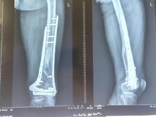 左股骨髁上,髁间粉碎性骨折