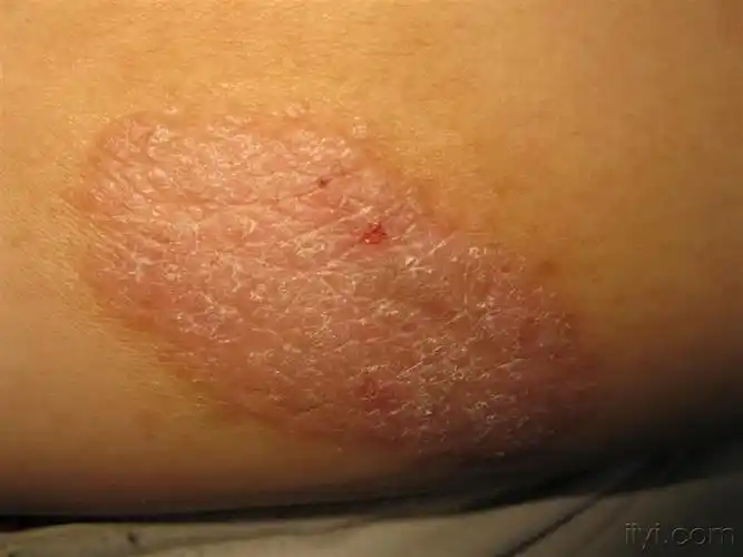 看图识病泛发性神经性皮炎