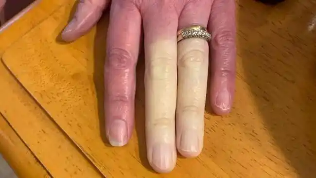 爱尔兰一位母亲身患怪病,一旦降温就会手指变白发麻|朱莉|雷诺|莫妮卡