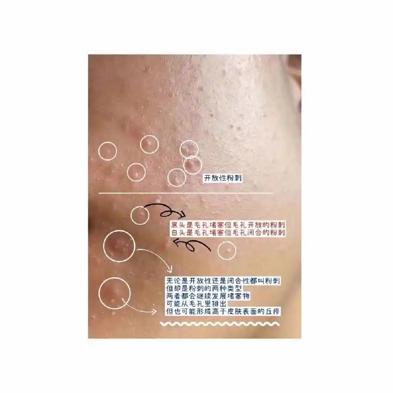 两种粉刺的区分,一图教你分辨出来93? 图片已缩小,介意慎点