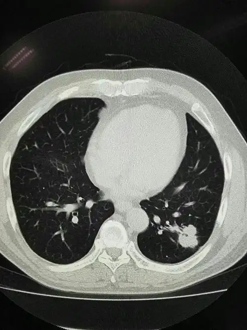 近心端空洞,与气管相通,无强化——肺结核.