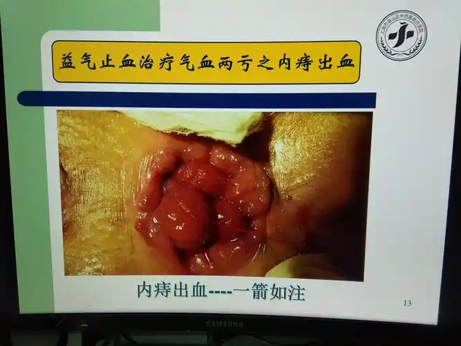 陆金根教授重用生黄芪治疗内痔出血 - 好大夫在线