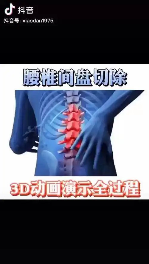 腰椎间盘突出切除手术3d动画演示全过程_腰椎间盘突出