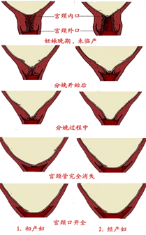 经产妇多是宫颈管消失与宫口扩张同时进行·初产妇多是宫颈管先消失