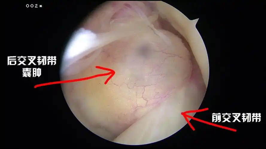 健康小伙突然膝盖伸不直病因竟是罕见的交叉韧带囊肿