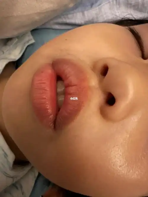 真假腺样体肥大