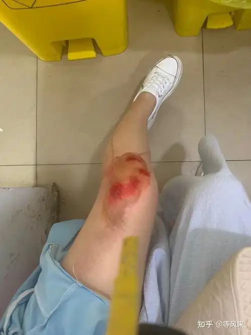 开一个膝盖腿伤恢复记录帖