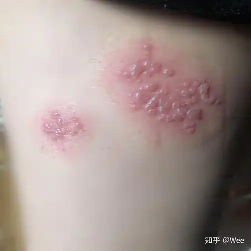 得了带状疱疹的症状及感受是什么