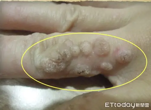 柯适中指出,近期也曾收治一名患者,手指长满了密密麻麻的病毒疣