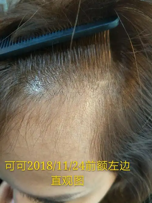 愿你头皮健康,青春永驻 - 美篇