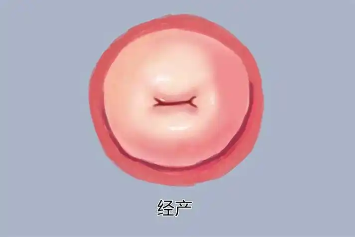 已产妇子宫颈外口图