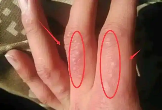 手上长好多小水泡,一抓很痒,抓破这处那一处又长了,是传染的吗