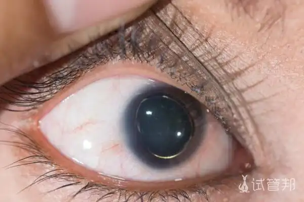 马凡综合征(马方综合征)发病症状有哪些