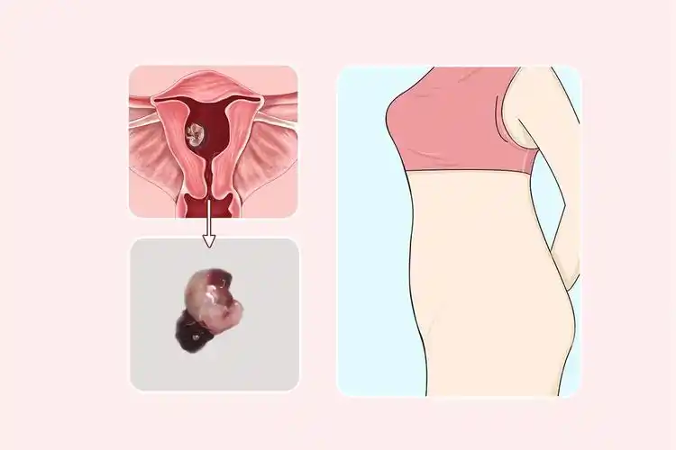 一个多月药流孕囊图片