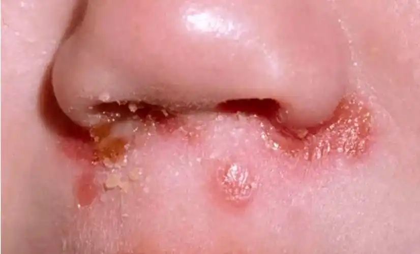 传染性超强的脓疱疮来了孩子们快跑