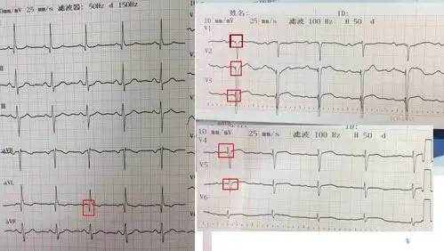 看看这样的异常q波,谢 - 心电图脑电图专业讨论版 - 爱爱医医学论坛