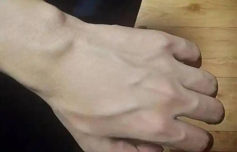 是不健康的表现吗?医生分析_静脉_血管_肿瘤