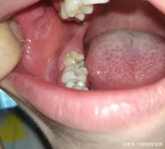 口腔白斑病和扁平苔藓的区别