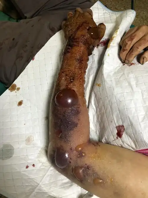 五步蛇咬伤重症,保命保肢,出院啦.