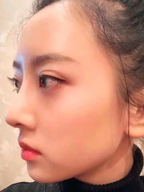 有经验的医生做鼻子真的很自然,超爱.