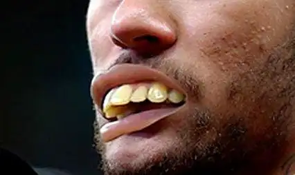 做龅牙矫正在什么年龄段合适