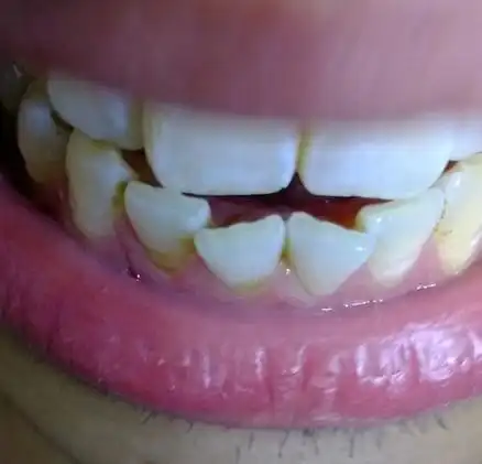 还会么 侧面看 两颗牙齿都很歪斜