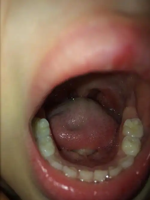 儿童扁桃体发炎红肿快一个月都没有好,感冒引起的,怎么回事,怎么医