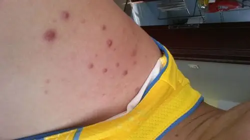 最近右肩膀上突然长些红疙瘩,不知道怎么回事,不痛不痒,刚开始起红红